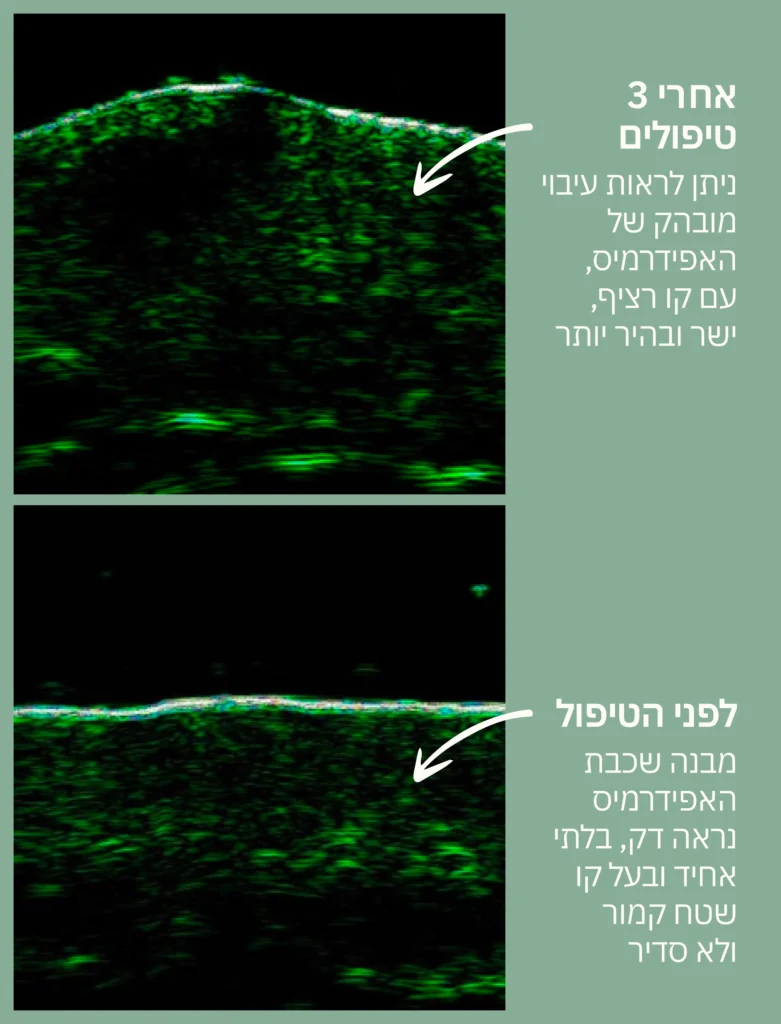 מחקר עלייה בגמישות ובחוזק רקמת העור