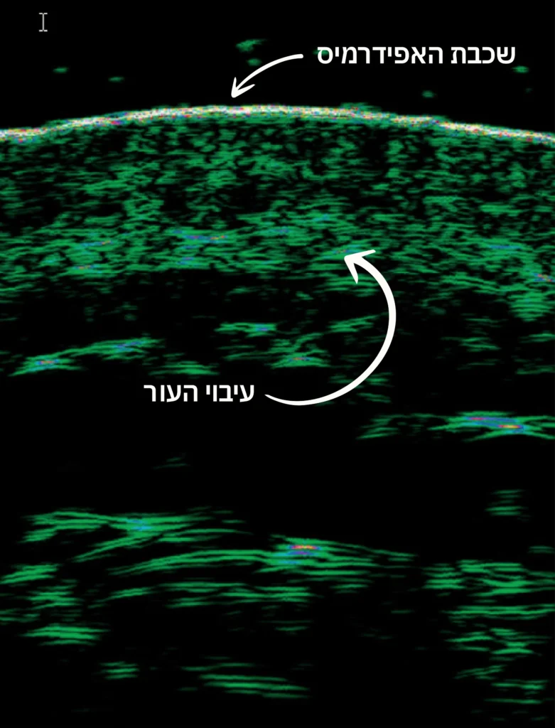 שינויים במבנה העור לאחר 2 טיפולים בלבד